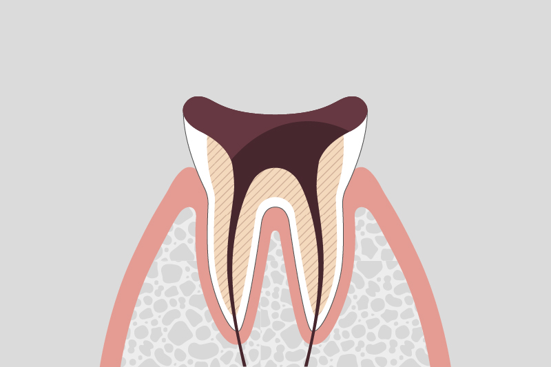 歯の根まで進行した虫歯