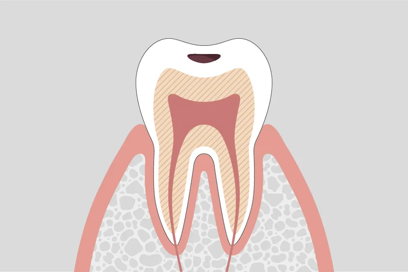 Early stage cavity treatment