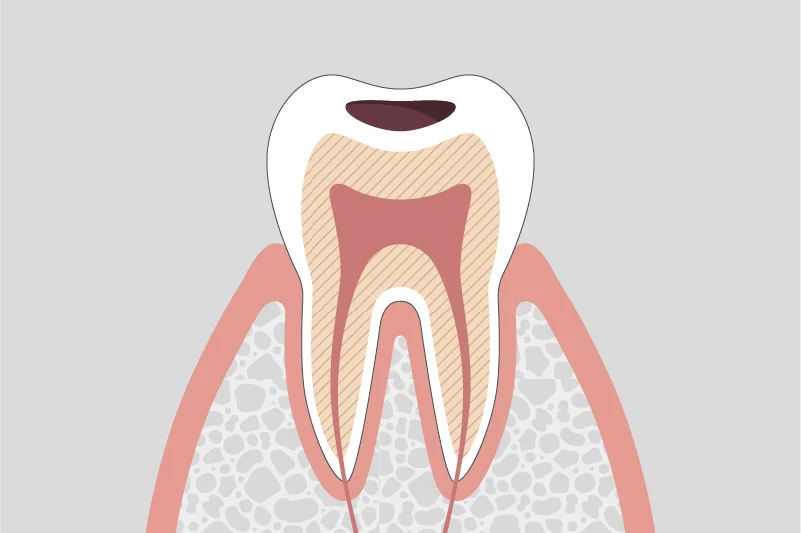 C1 enamel cavity treatment