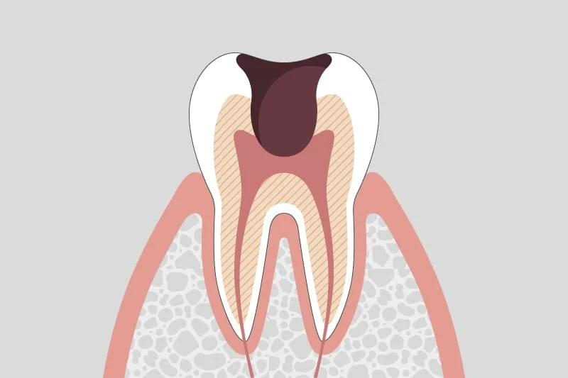 C3: Cavity reaching the nerve