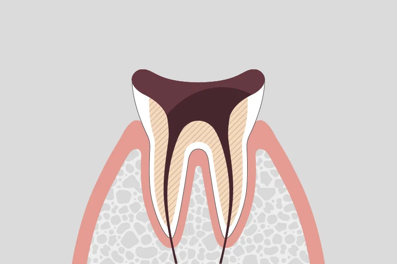 C4: Only the tooth root remains