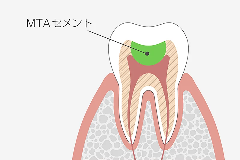 MTAセメントの活用