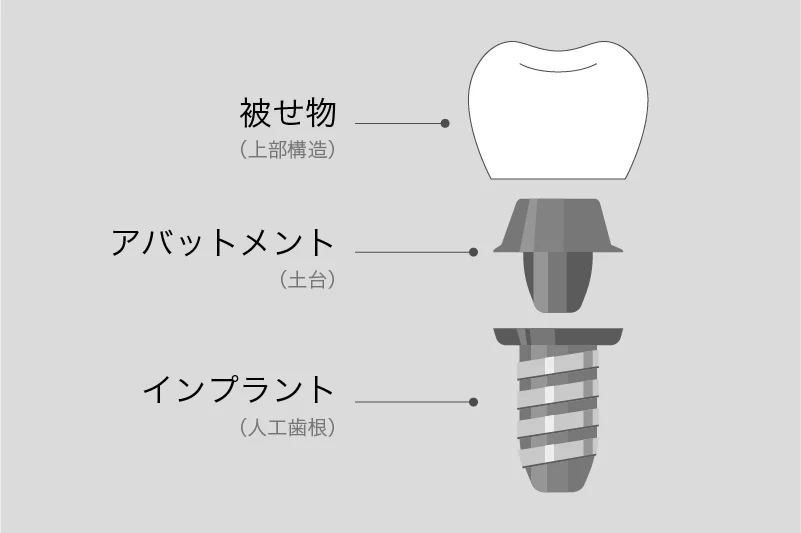 インプラント治療の仕組み図