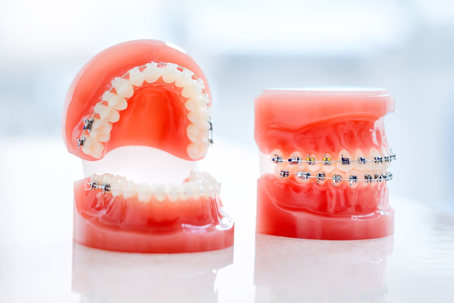 ワイヤー矯正（マルチブラケット矯正）